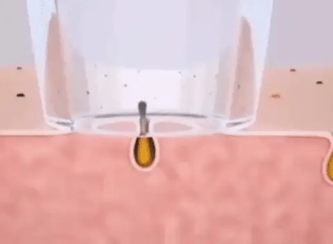 Removedor Super Vaco de Cravo e Espinha